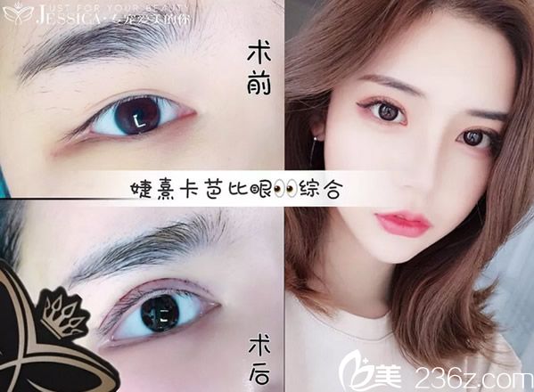 婕熹卡全切双眼皮+开眼角真人案例 婕熹卡全切双眼皮+开眼角真人案例