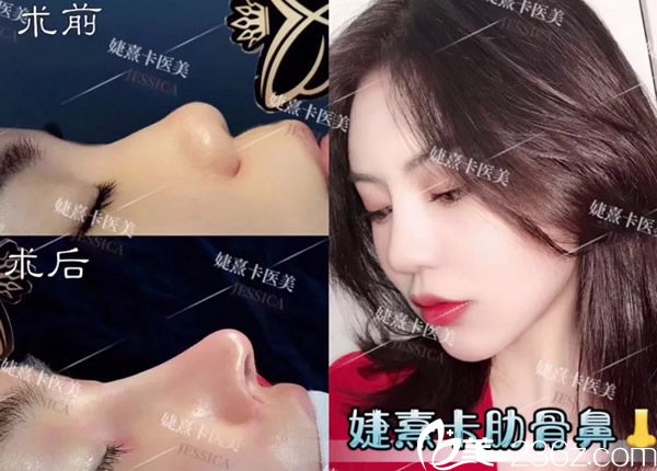 香港婕熹卡自体肋软骨隆鼻效果案例 香港婕熹卡自体肋软骨隆鼻效果案例