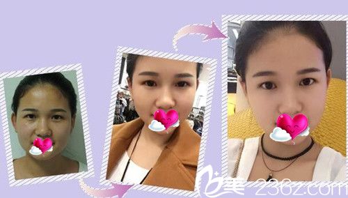 CLINICX无创微整形玻尿酸+案例效果图