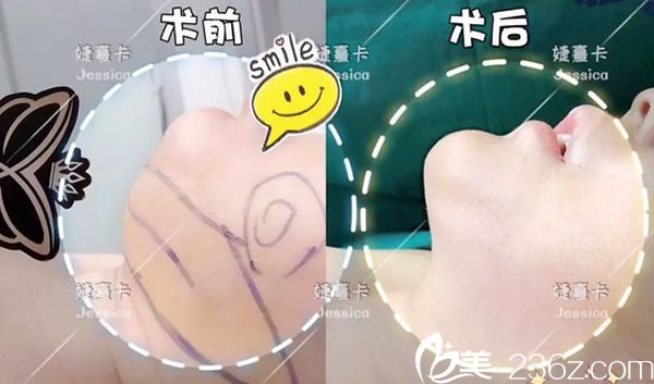 香港婕熹卡双下巴吸脂效果怎么样 香港婕熹卡双下巴吸脂效果怎么样