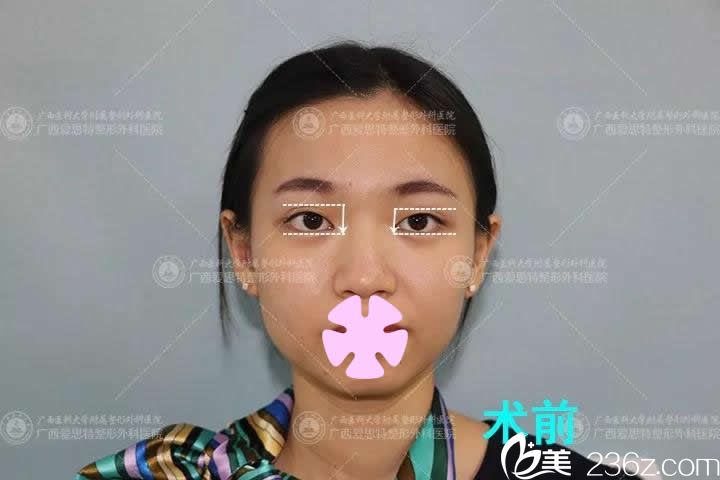 我在南宁爱思特整形做双眼皮前的照片 我在南宁爱思特整形做双眼皮前的照片