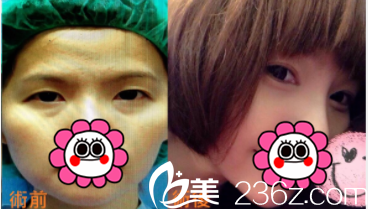 中国台湾京媛双眼皮案例 中国台湾京媛双眼皮案例