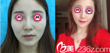 中国台湾京媛隆鼻案例 中国台湾京媛隆鼻案例