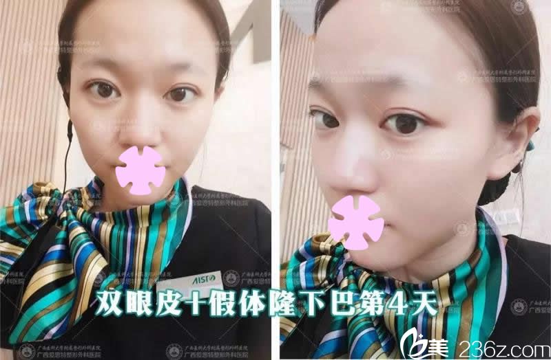 我在南宁爱思特整形做双眼皮和假体垫下巴术后第4天照片 我在南宁爱思特整形做双眼皮和假体垫下巴术后第4天照片