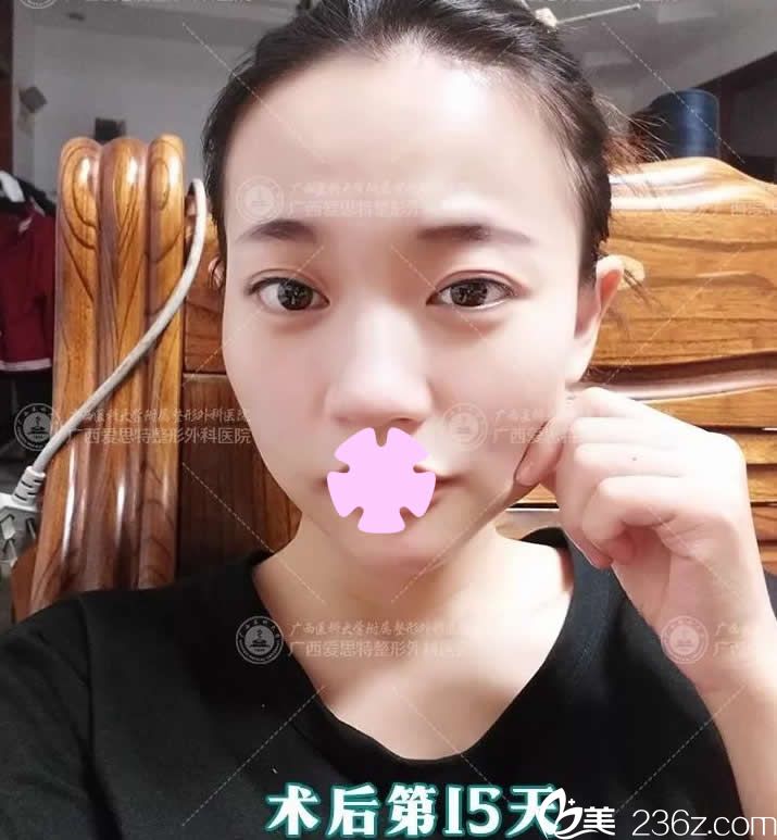 我在南宁爱思特整形做眼睛和下巴术后第15天照片 我在南宁爱思特整形做眼睛和下巴术后第15天照片