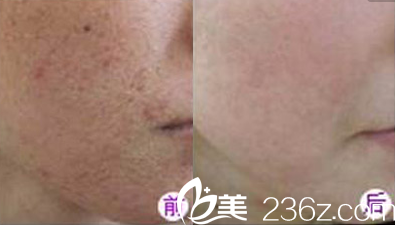 中国台湾京媛刘贤佐医生祛斑案例 中国台湾京媛刘贤佐医生祛斑案例