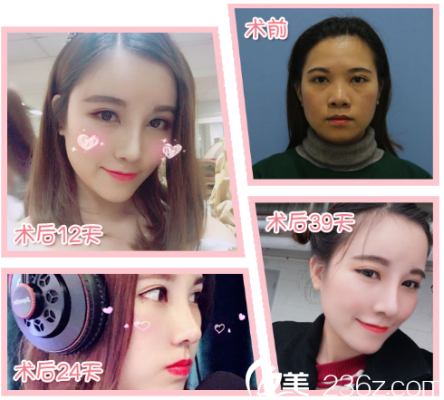 广州紫馨谷琪做隆鼻子怎么样