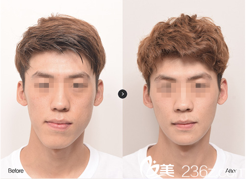 下颌角手术案例 下颌角手术案例