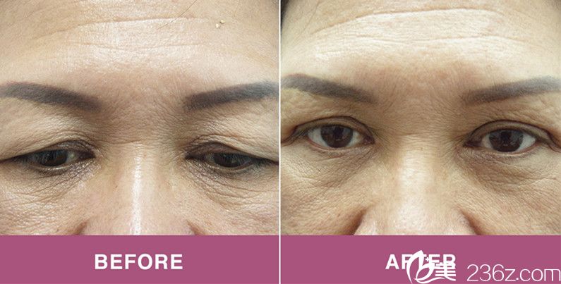 上睑成形术前后对比照