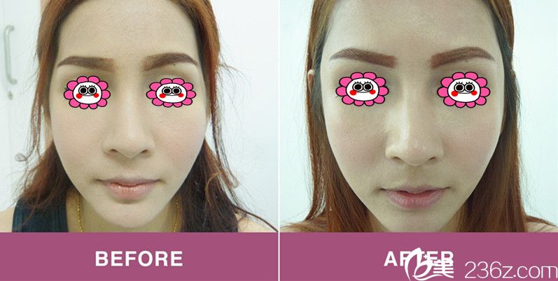 面部脂肪填充效果图