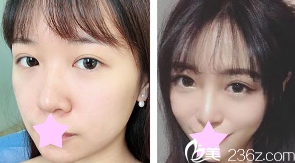 王朝辉瘦脸效果对比图 王朝辉瘦脸效果对比图