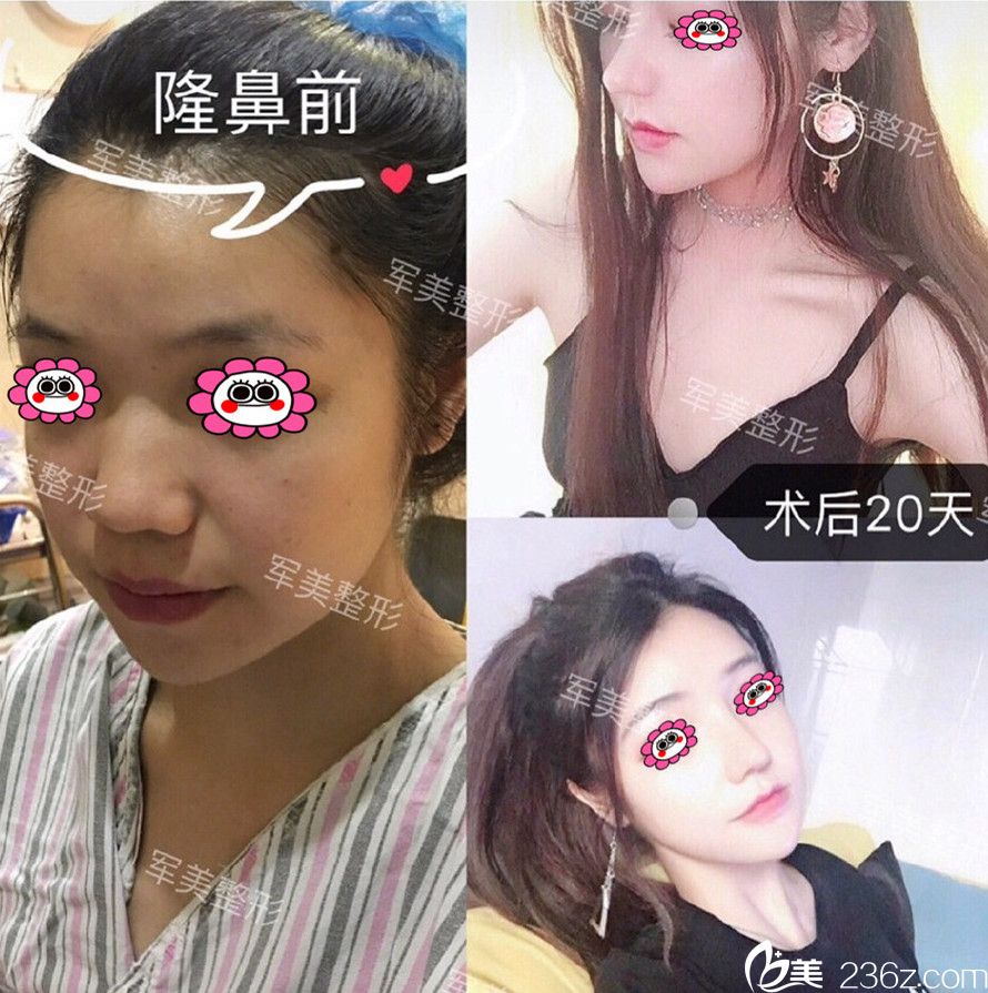 广州军美隆鼻案例变化图 广州军美隆鼻案例变化图