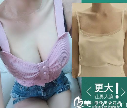 广州军美王世虎隆胸效果图 广州军美王世虎隆胸效果图