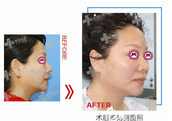 北京基恩埋线提升多少钱？全面部线雕提升7800元起附案例