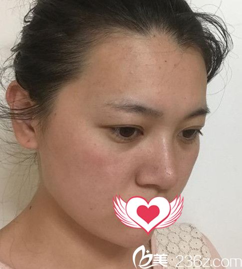 合肥华美杨鹏给我做鼻综合隆鼻术后第10天拆线后照片