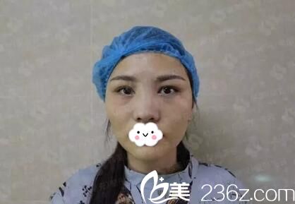 术前鼻梁塌鼻头大拉低颜值 术前鼻梁塌鼻头大拉低颜值