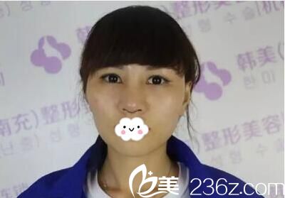 南充韩美鼻综合整形术后3天图片 南充韩美鼻综合整形术后3天图片
