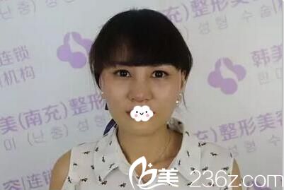 鼻头缩小手术拆线后效果 鼻头缩小手术拆线后效果