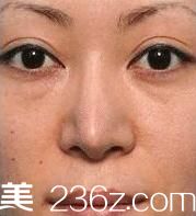 福田庆三隆鼻技术好吗?分享一下我在日本美容美真医院做的鼻部修复手术案例照片
