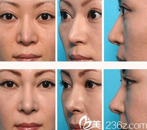 日本美容美真医院做的鼻部修复手术案例照片 日本美容美真医院做的鼻部修复手术案例照片