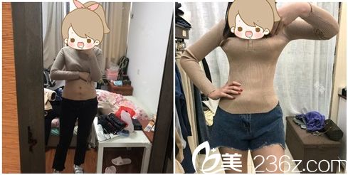 宁波鄞州壹加壹美容医院吸脂<span style= 宁波鄞州壹加壹美容医院吸脂<span style=