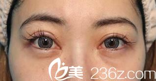 双眼皮修复、去眼袋和眼睑下至手术前 双眼皮修复、去眼袋和眼睑下至手术前