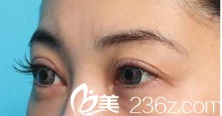 日本美真美容整形医院双眼皮修复案例