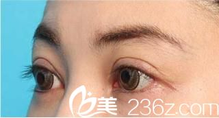 双眼皮修复、去眼袋和眼睑下至侧面展示 双眼皮修复、去眼袋和眼睑下至侧面展示