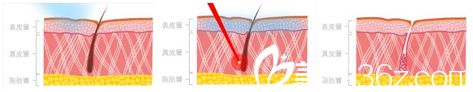 卓健医疗激光脱毛原理 卓健医疗激光脱毛原理