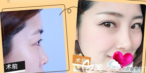 看苏州康美刘道功做双眼皮怎么样 看苏州康美刘道功做双眼皮怎么样