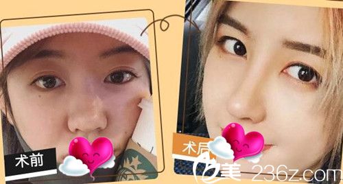 苏州康美整形陈勇隆鼻效果图 苏州康美整形陈勇隆鼻效果图