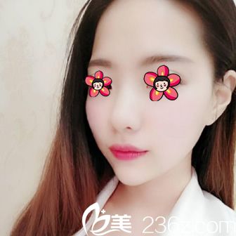 注射玻尿酸填充下巴7天恢复照