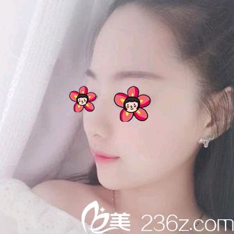 注射玻尿酸填充下巴15天后