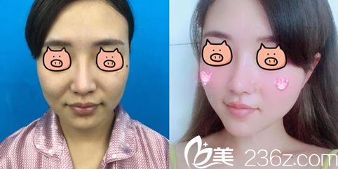 欧阳慧恩注射瘦脸除皱瘦脸案例效果 欧阳慧恩注射瘦脸除皱瘦脸案例效果