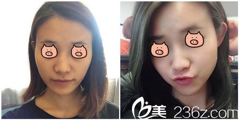 欧阳慧恩主任聚焦超声波紧肤术后效果 欧阳慧恩主任聚焦超声波紧肤术后效果