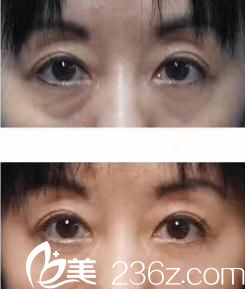 花园美容整形医院自体脂肪注入填充祛眼袋前后对比 花园美容整形医院自体脂肪注入填充祛眼袋前后对比