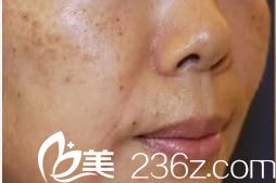 日本花园美容整形医院皮秒激光祛斑前 日本花园美容整形医院皮秒激光祛斑前