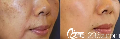 大庭英信医生皮秒激光祛斑前后对比 大庭英信医生皮秒激光祛斑前后对比