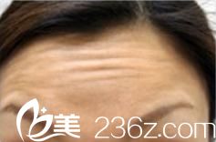 城野医生瘦脸除皱注射前 城野医生瘦脸除皱注射前