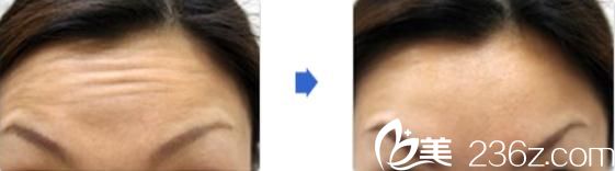 日本城野医生医疗美容医院瘦脸除皱注射前后对比 日本城野医生医疗美容医院瘦脸除皱注射前后对比