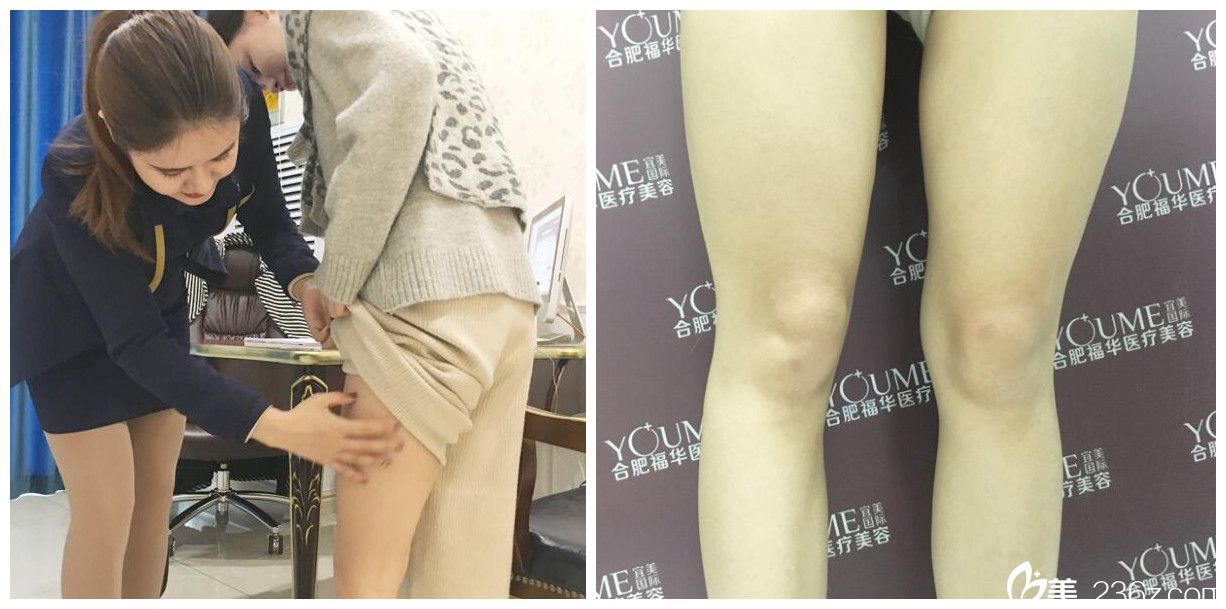 找赵章杰做大腿环吸术前面诊及拍照 找赵章杰做大腿环吸术前面诊及拍照