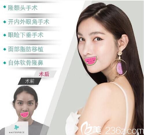 泰国马斯特皮诊所双眼皮隆鼻脂肪填充案例 泰国马斯特皮诊所双眼皮隆鼻脂肪填充案例