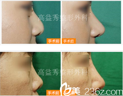 韩国高益秀鼻部整形前后对比