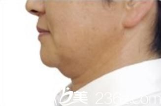 城野亲德院长做热玛吉紧肤前 城野亲德院长做热玛吉紧肤前