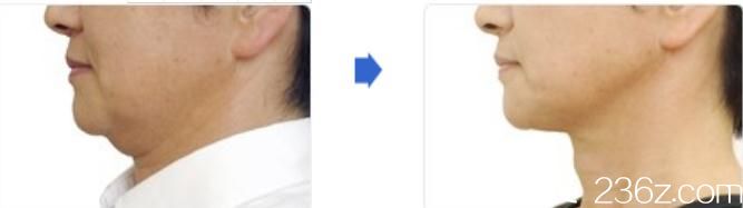 日本城野医生医疗美容医院热玛吉紧肤前后对比变化 日本城野医生医疗美容医院热玛吉紧肤前后对比变化