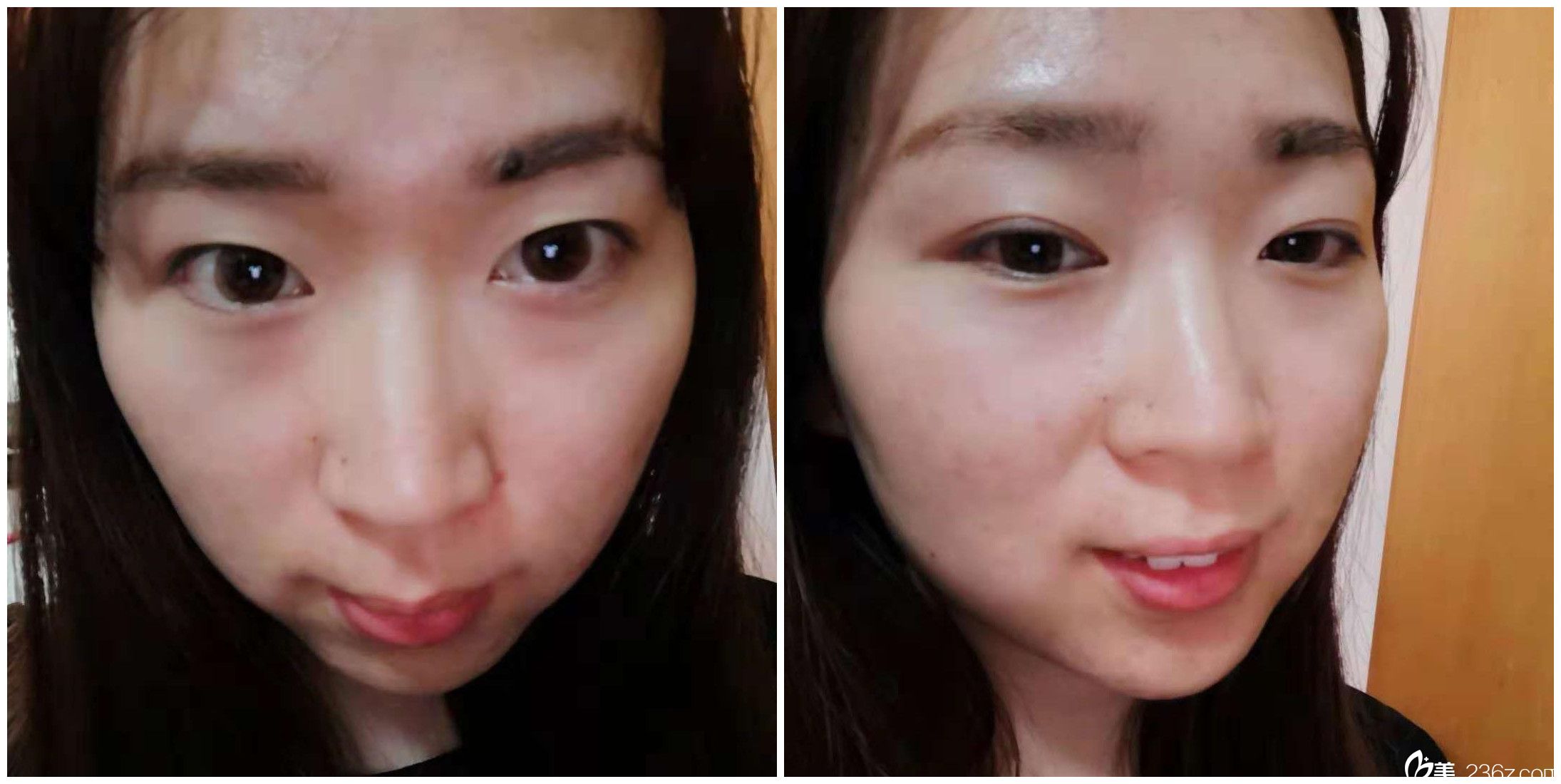 找孙佳佳主任做次微针塑美后14天 找孙佳佳主任做次微针塑美后14天