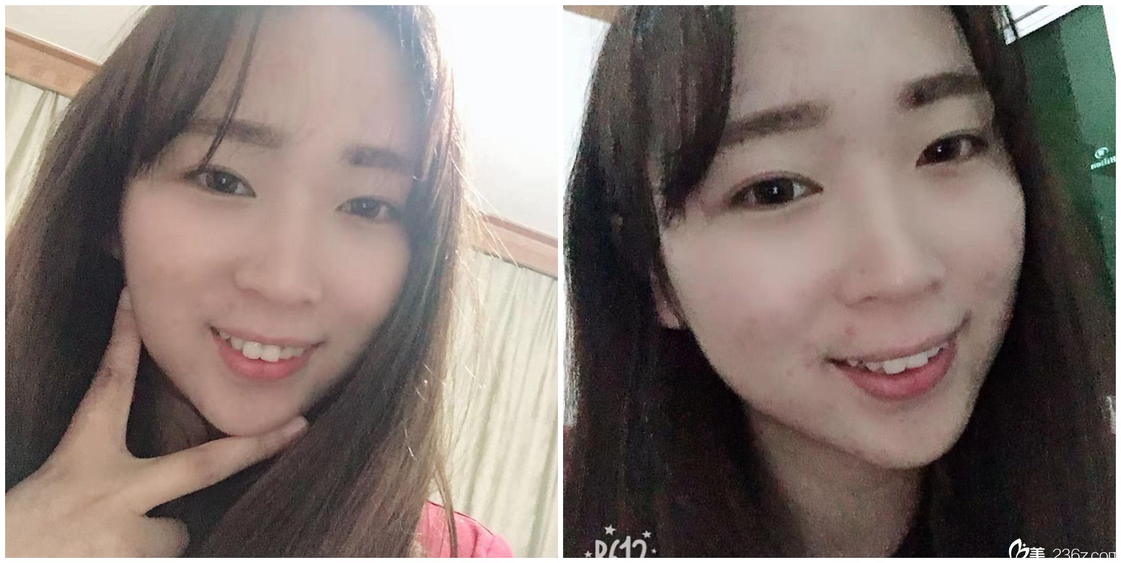 合肥壹美尚整形次微针美塑后30天效果 合肥壹美尚整形次微针美塑后30天效果