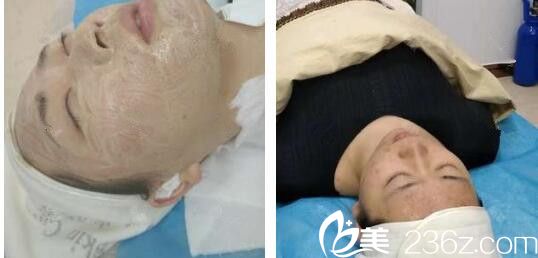 壹美尚整形微针美塑第88天恢复情况 壹美尚整形微针美塑第88天恢复情况