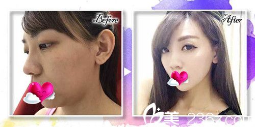 中国台湾立新美学诊所Quill8字线雕拉提案例