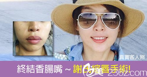 中国台湾立新美学诊所谢东颖缩唇手术案例